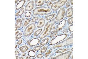 Immunohistochemistry of paraffin-embedded human liver cancer using GAPDH Mouse mAb (ABIN3020540, ABIN3020541, ABIN3020542 and ABIN1512934) at dilution of 1:100 (40x lens). (GAPDH Antikörper)