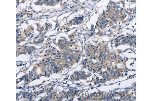Immunohistochemistry of Human gastric cancer using CAPZA2 Polyclonal Antibody at dilution of 1:30