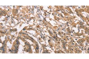 Immunohistochemistry of paraffin-embedded Human colon cancer using PEBP1 Polyclonal Antibody at dilution of 1:40 (PEBP1 Antikörper)