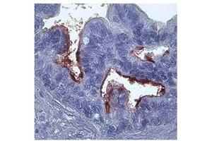 MMP1 in epithelial cells ovarian carcinoma was detected using HRP/DAB brown color stain. (MMP1 Antikörper)