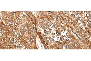 Immunohistochemistry of paraffin-embedded Human liver cancer tissue using CAD Polyclonal Antibody at dilution of 1:50(x200) (CAD Antikörper)