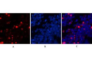 Immunofluorescence analysis of human lung cancer tissue. (Caspase 3 p17 (AA 100-180), (Cleaved-Asp175) Antikörper)