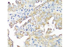 Immunohistochemistry of paraffin-embedded Human lung cancer using EIF3B Polyclonal Antibody at dilution of 1:100 (40x lens). (EIF3B Antikörper)
