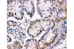 Anti-MCM5 antibody, IHC(P) IHC(P): Human Intestinal Cancer Tissue (MCM5 Antikörper  (C-Term))