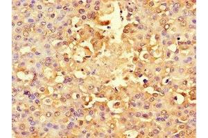 Immunohistochemistry of paraffin-embedded human breast cancer using ABIN7142567 at dilution of 1:100 (RPS6 Antikörper  (AA 35-229))