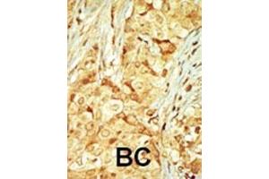 Formalin-fixed and paraffin-embedded human cancer tissue reacted with the primary antibody, which was peroxidase-conjugated to the secondary antibody, followed by DAB staining. (MOK Antikörper  (C-Term))