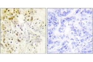 Immunohistochemistry analysis of paraffin-embedded human breast carcinoma tissue, using Cyclin L1 Antibody. (Cyclin L1 Antikörper  (AA 461-510))