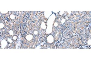 Immunohistochemistry of paraffin-embedded Human thyroid cancer tissue using FKBPL Polyclonal Antibody at dilution of 1:50(x200) (FKBPL Antikörper)