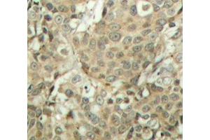 Immunohistochemistry of paraffin-embedded Human breast carcinoma tissue, using Phospho-CFL1(S3) Polyclonal Antibody (Cofilin Antikörper  (pSer3))