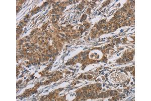 Immunohistochemistry of Human gastric cancer using AGER Polyclonal Antibody at dilution of 1:70 (RAGE Antikörper)