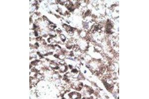Formalin-fixed and paraffin-embedded human cancer tissue reacted with the primary antibody, which was peroxidase-conjugated to the secondary antibody, followed by DAB staining. (GPR37 Antikörper  (C-Term))