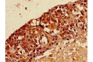 Immunohistochemistry of paraffin-embedded human breast cancer using ABIN7159273 at dilution of 1:100 (MAGEA8 Antikörper  (AA 1-270))