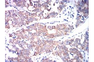 Immunohistochemical analysis of paraffin-embedded cervical cancer tissues using ADAM10 mouse mAb with DAB staining. (ADAM10 Antikörper)
