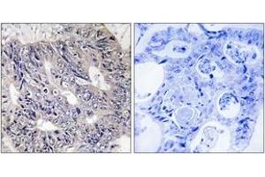 Immunohistochemistry analysis of paraffin-embedded human colon carcinoma tissue, using ES8L1 Antibody. (EPS8-Like 1 Antikörper  (AA 411-460))