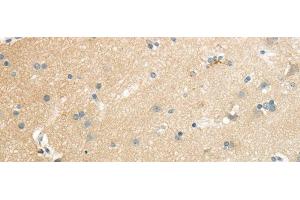 Immunohistochemistry (Paraffin-embedded Sections) (IHC (p)) image for anti-Solute Carrier Family 7, (Cationic Amino Acid Transporter, Y+ System) Member 11 (SLC7A11) antibody (ABIN7244450)