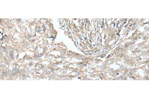 Immunohistochemistry of paraffin-embedded Human lung cancer tissue using VILL Polyclonal Antibody at dilution of 1:65(x200)