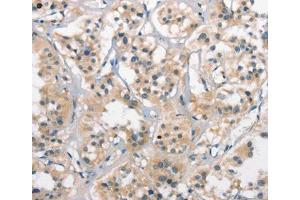 Immunohistochemical analysis of paraffin-embedded Human thyroid cancer tissue using at dilution 1/25. (CTAG1A Antikörper  (Internal Region))
