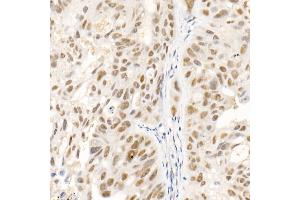 Immunohistochemistry of paraffin-embedded human colon carcinoma using SOCS1 Rabbit mAb (ABIN7270640) at dilution of 1:100 (40x lens). (SOCS1 Antikörper)