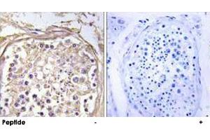 Immunohistochemistry analysis of paraffin-embedded human breast carcinoma tissue using CHST9 polyclonal antibody . (CHST9 Antikörper)