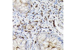 Immunohistochemistry of paraffin-embedded human colon carcinoma using Gelsolin Rabbit pAb (ABIN7267365) at dilution of 1:50 (40x lens).