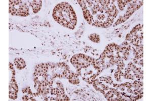 IHC-P Image Immunohistochemical analysis of paraffin-embedded human breast cancer, using ZNF148 antibody [N1N2], N-term, antibody at 1:250 dilution. (ZNF148 Antikörper  (N-Term))