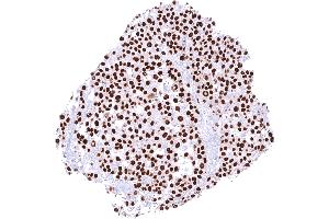 Malignant melanoma of the skin with strong nuclear SOX10 staining of all tumor cells