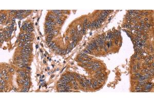 Immunohistochemistry of paraffin-embedded Human colon cancer using ERP29 Polyclonal Antibody at dilution of 1:40 (ERP29 Antikörper)