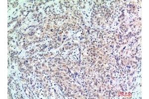 Immunohistochemistry (IHC) analysis of paraffin-embedded Human Breast Cancer, antibody was diluted at 1:200. (p300 Antikörper)