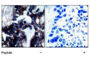 Immunohistochemical analysis of paraffin-embedded human breast carcinoma tissue, using RPS6KB1 (phospho S424) polyclonal antibody . (RPS6KB1 Antikörper  (pSer424))