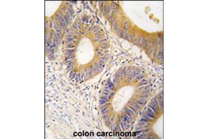 Formalin-fixed and paraffin-embedded human colon carcinoma tissue reacted with ALDOC polyclonal antibody  , which was peroxidase-conjugated to the secondary antibody, followed by DAB staining. (ALDOC Antikörper  (C-Term))