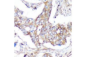 Immunohistochemistry of paraffin-embedded Human colon carcinoma using C Rabbit pAb (ABIN7266547) at dilution of 1:100 (40x lens). (CAND2 Antikörper  (AA 850-1000))