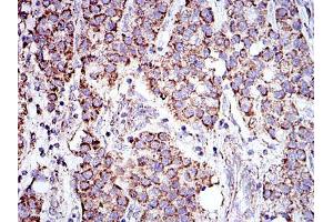 Immunohistochemical analysis of paraffin-embedded liver cancer tissues using PHB mouse mAb with DAB staining. (Prohibitin Antikörper)