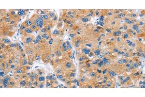 Immunohistochemistry of paraffin-embedded Human liver cancer tissue using DKK2 Polyclonal Antibody at dilution 1:60 (DKK2 Antikörper)