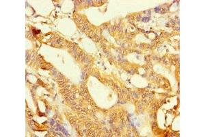 Immunohistochemistry of paraffin-embedded human colon cancer using ABIN7158821 at dilution of 1:100 (LYG2 Antikörper  (AA 20-212))