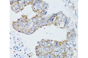 Immunohistochemistry of paraffin-embedded Human rectal cancer using EGFR Polyclonal Antibody at dilution of 1:100 (40x lens). (EGFR Antikörper)