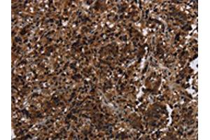 The image on the left is immunohistochemistry of paraffin-embedded Human liver cancer tissue using ABIN7191356(MAGEE1 Antibody) at dilution 1/30, on the right is treated with synthetic peptide. (MAGEE1 Antikörper)