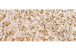Immunohistochemistry of paraffin-embedded Human liver cancer tissue using PDXK Polyclonal Antibody at dilution of 1:75(x200) (PDXK Antikörper)