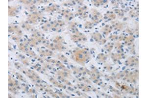 The image on the left is immunohistochemistry of paraffin-embedded Human liver cancer tissue using ABIN7190267(CKMT1A/CKMT1B Antibody) at dilution 1/80, on the right is treated with synthetic peptide. (CKMT1A Antikörper)