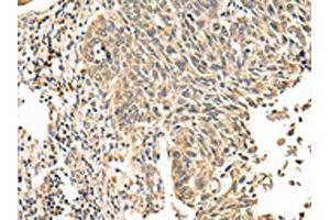 The image on the left is immunohistochemistry of paraffin-embedded Human lung cancer tissue using ABIN7131591(VPS53 Antibody) at dilution 1/20, on the right is treated with fusion protein. (VPS53 Antikörper)