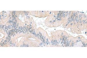 Immunohistochemistry of paraffin-embedded Human colorectal cancer tissue using UBE2F Polyclonal Antibody at dilution of 1:70(x200)