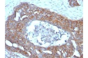 IHC testing of FFPE human ovarian carcinoma with Estrogen Inducible Protein pS2 antibody (TFF1 Antikörper  (C-Term))