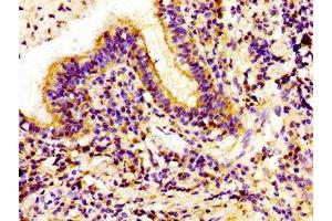 Immunohistochemistry of paraffin-embedded human lung cancer using ABIN7157016 at dilution of 1:100 (Involucrin Antikörper  (AA 24-118))