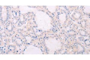 Immunohistochemistry of paraffin-embedded Human thyroid cancer tissue using TSHR Polyclonal Antibody at dilution 1:50 (TSH receptor Antikörper)