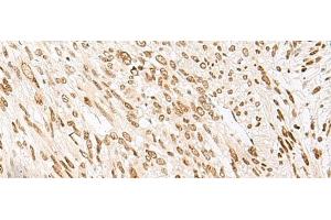 Immunohistochemistry of paraffin-embedded Human liver cancer tissue using NHP2 Polyclonal Antibody at dilution of 1:55(x200)
