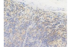 ABIN6264249 and ABIN6269096 at 1/100 staining human melanoma by IHC-P. (PKC beta Antikörper  (C-Term))
