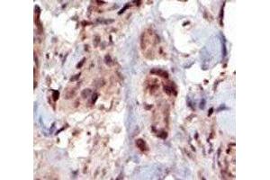 IHC analysis of FFPE human breast carcinoma tissue stained with the SPHK2 antibody (SPHK2 Antikörper  (AA 590-620))