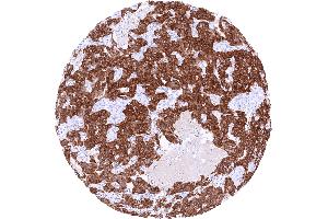 Pancreatic neuroendocrine tumor with strong GAD2 immunostaining of tumor cells (GAD65 Antikörper  (AA 6-99))