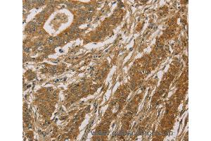 Immunohistochemistry of Human thyroid cancer using CYP39A1 Polyclonal Antibody at dilution of 1:50