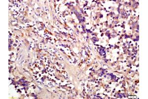 Formalin-fixed and paraffin embedded human lung carcinoma labeled with Anti-phospho-eIF4EBP1(Ser64) Polyclonal Antibody, Unconjugated (ABIN682963) at 1:200 followed by conjugation to the secondary antibody and DAB staining (eIF4EBP1 Antikörper  (pSer65))
