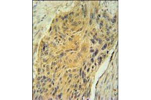 AVP Antibody immunohistochemistry analysis in formalin fixed and paraffin embedded human lung carcinoma followed by peroxidase conjugation of the secondary antibody and DAB staining.